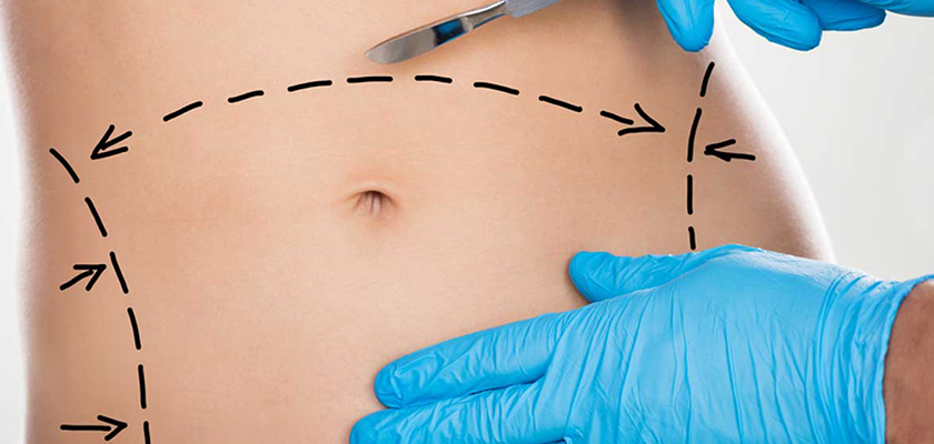 Abdominoplasty ( Tummy Tuck ) Surgery