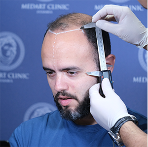Best Hair Transplant Method