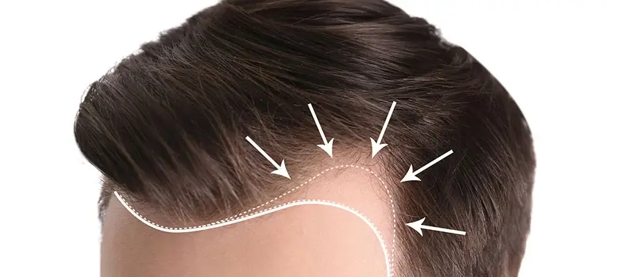 Hair transplant hairline analysis
