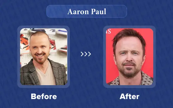 aaron paul hair transplant