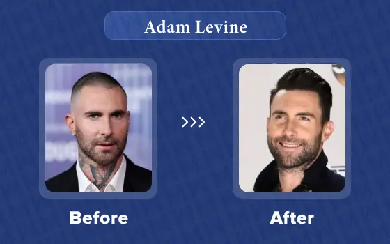 adam levine hair transplant
