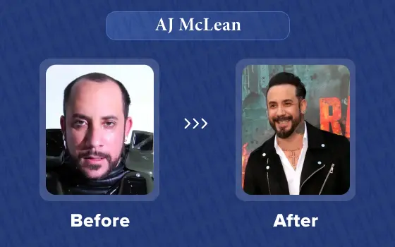 aj mclean hair transplant