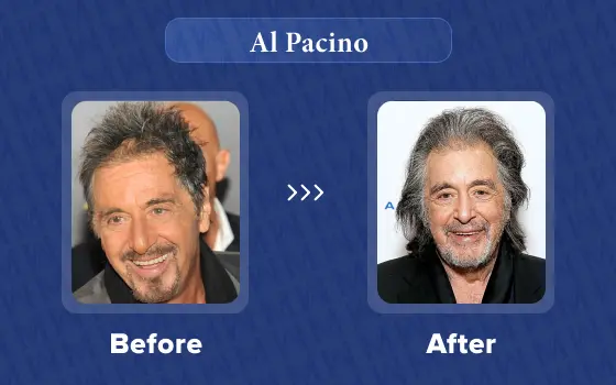al pacino hair transplant