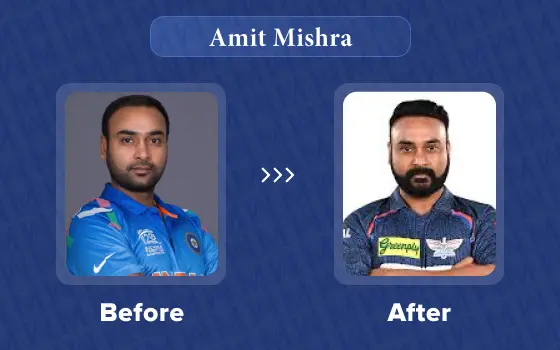 amit mishra hair transplant