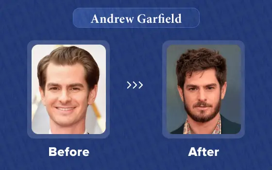 andrew garfield hair transplant