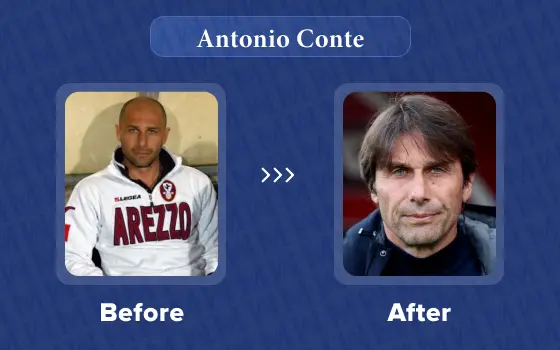 antonio conte hair transplant