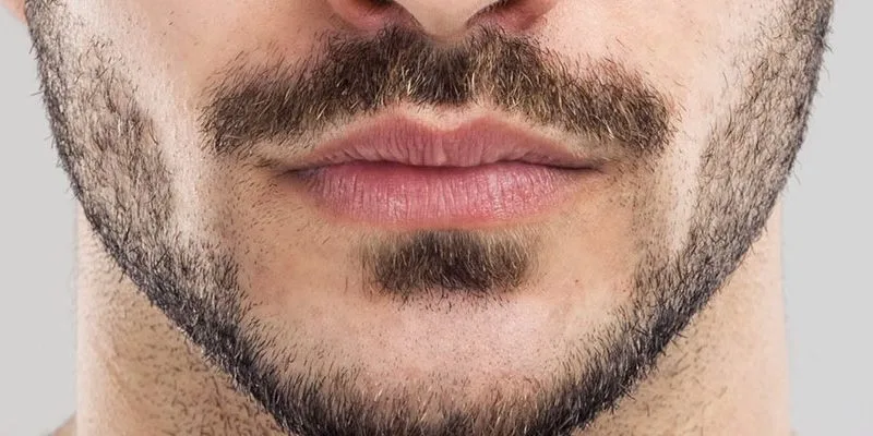 Beard Transplantation Turkey