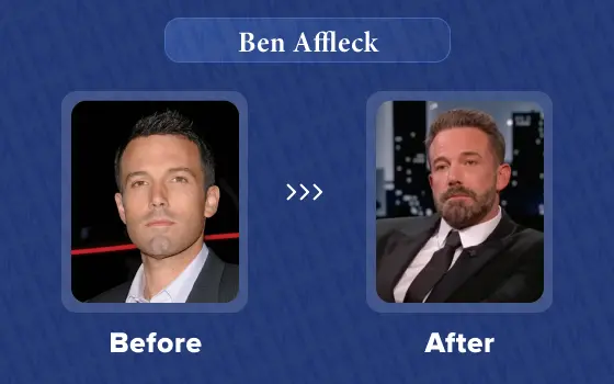 ben affleck hair transplant