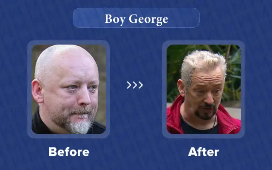 boy george hair transplant