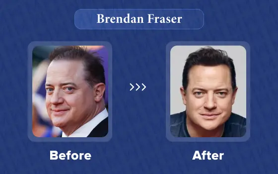brendan fraser hair transplant