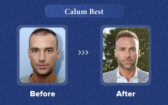 calum best hair transplant
