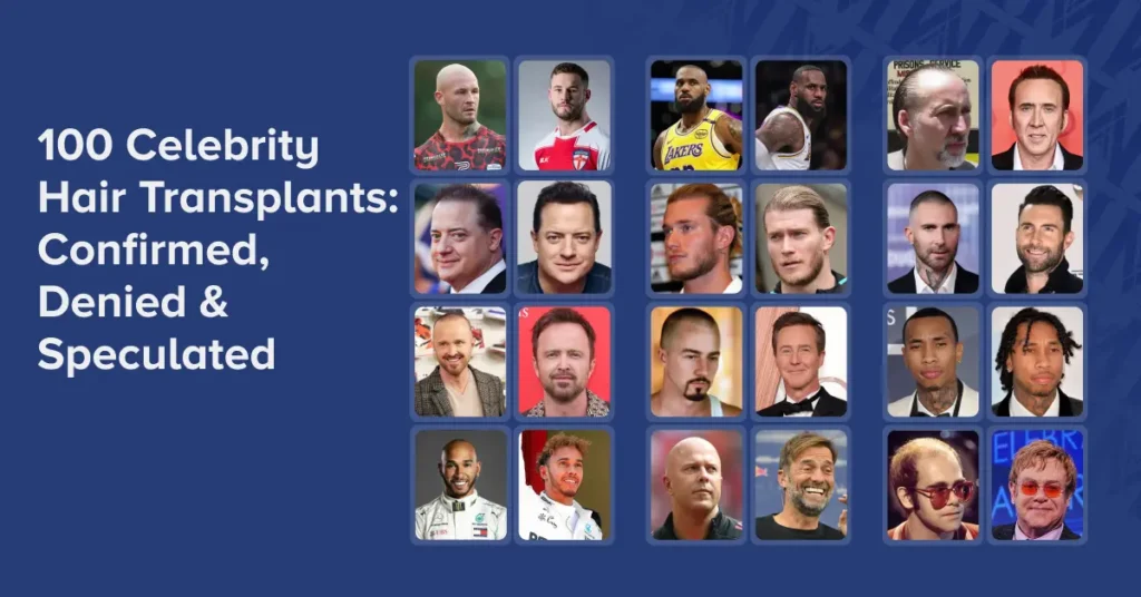 celebrity hair transplants featured image