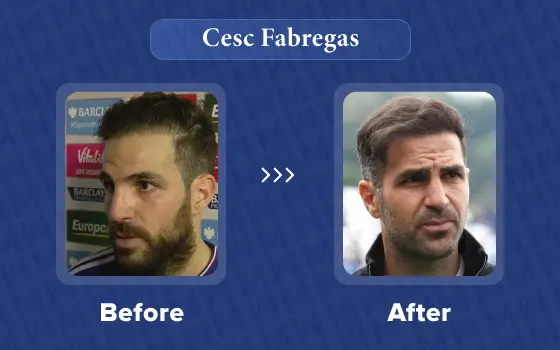 cesc fabregas hair transplant