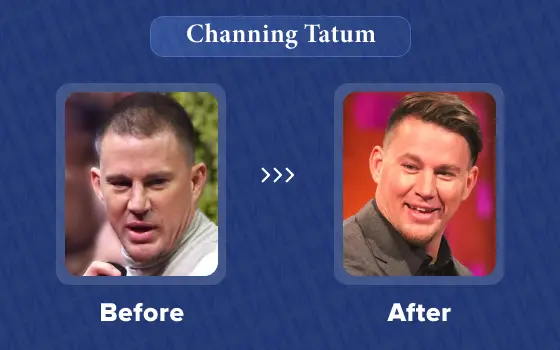 channing tatum hair transplant