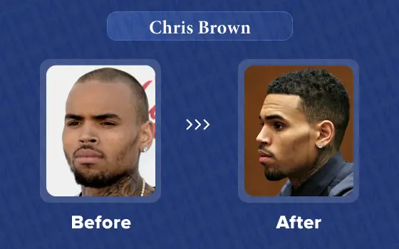 chris brown hair transplant