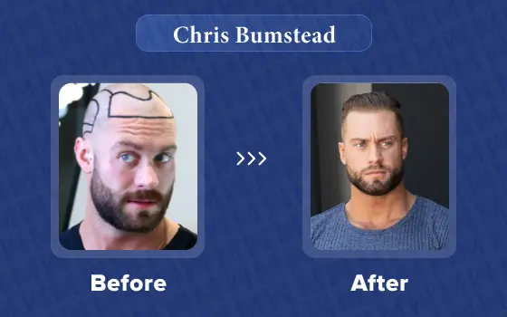 chris bumstead hair transplant