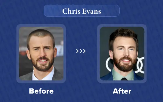chris evans hair transplant