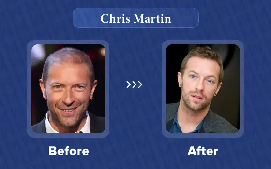 chris martin hair transplant