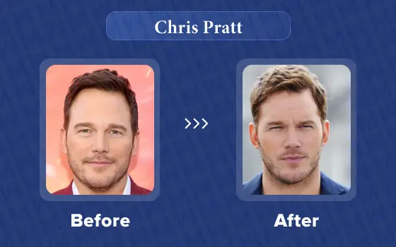 chris pratt hair transplant