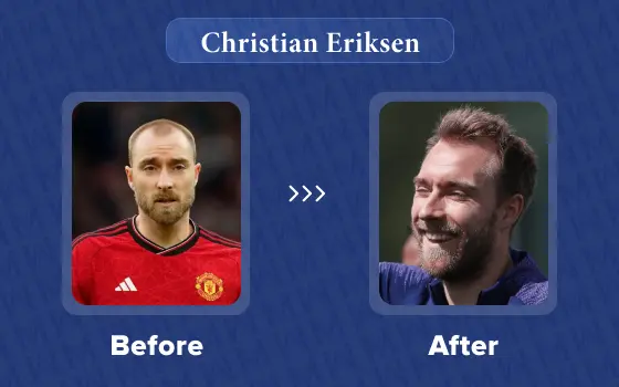 christian eriksen hair transplant