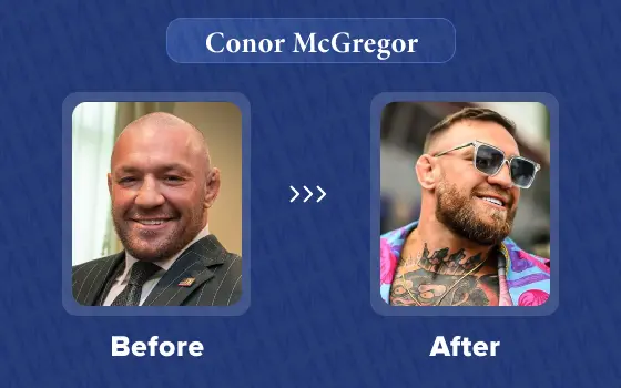 conor mcgregor hair transplant