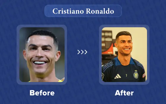 cristiano ronaldo hair transplant