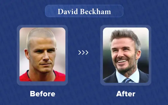 david beckham hair transplant