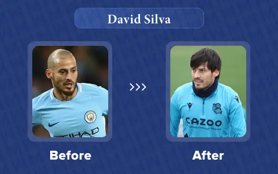 david silva hair transplant
