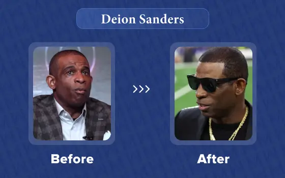 deion sanders hair transplant