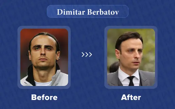 dimitar berbatov hair transplant