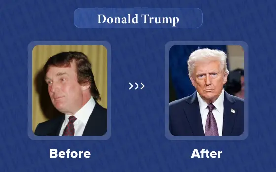 donald trump hair transplant