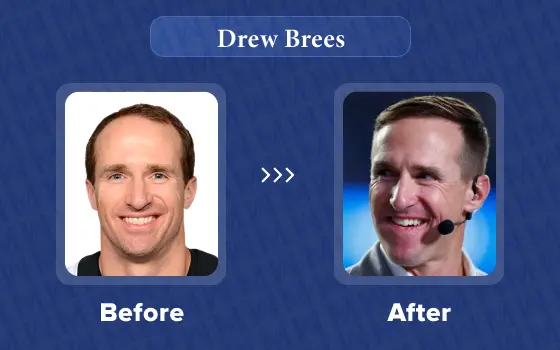 drew brees hair transplant