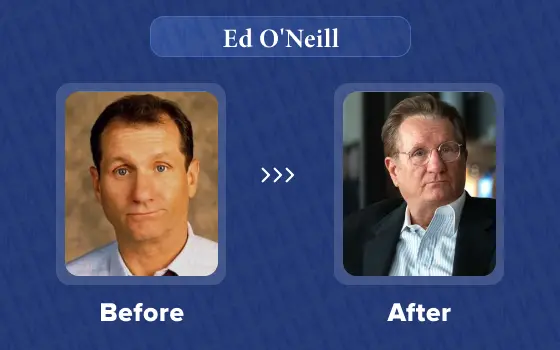 ed oneill hair transplant