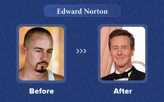 edward norton hair transplant