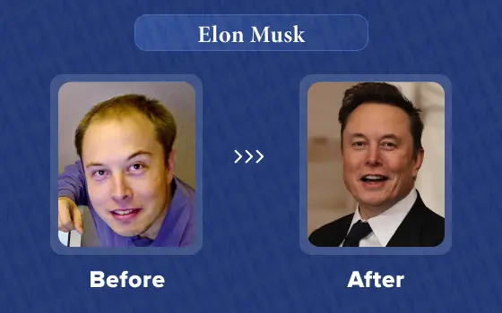 elon musk hair transplant