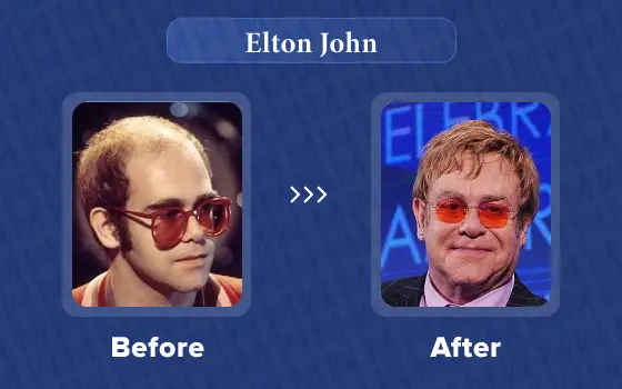 elton john hair transplant
