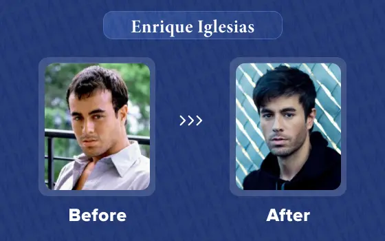 enrique iglesias hair transplant