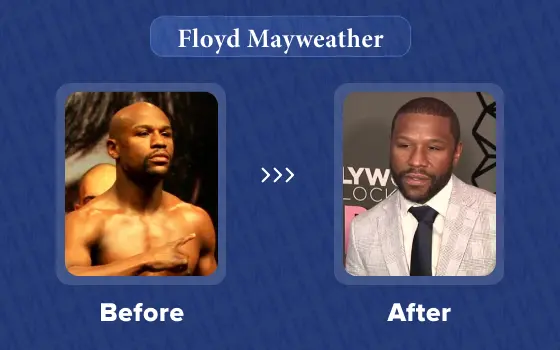 floyd mayweather hair transplant
