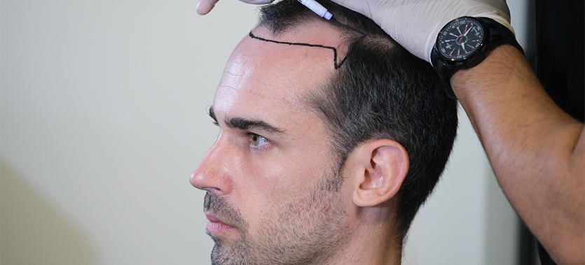 fue hair transplant