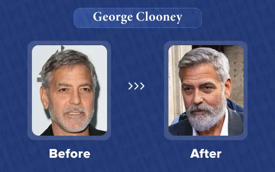 george clooney hair transplant
