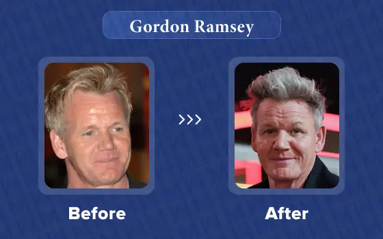 gordon ramsay hair transplant