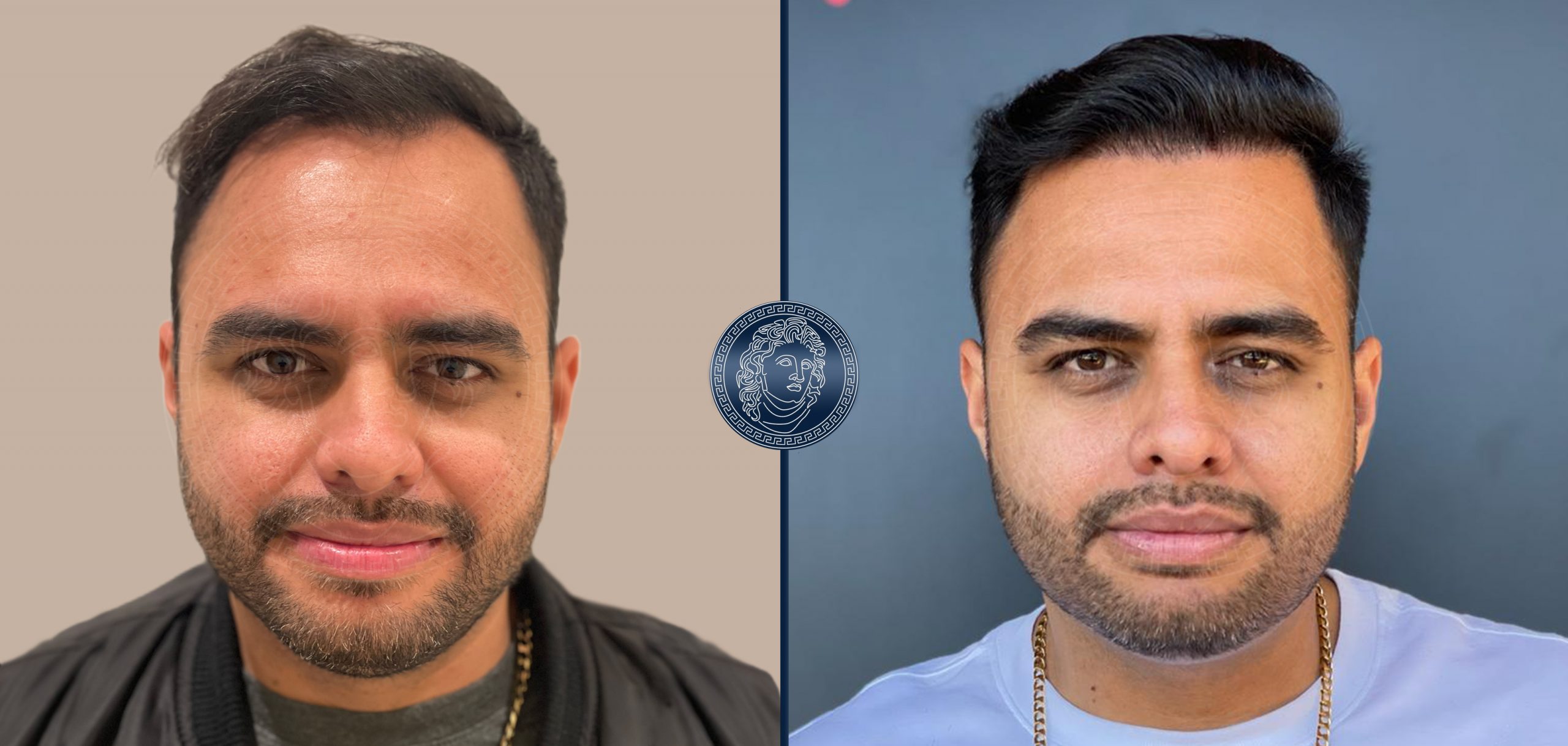 Hair Transplant Before and After Results