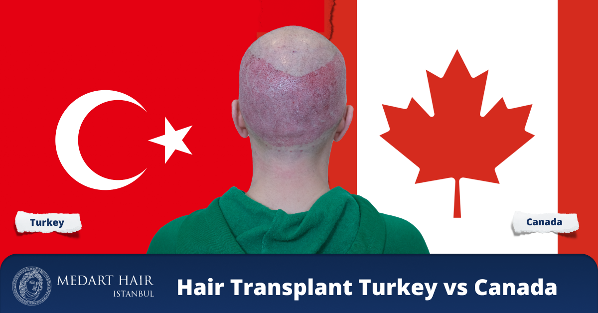 hair transplant canada vs turkey