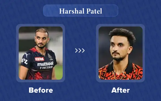 harshal patel hair transplant
