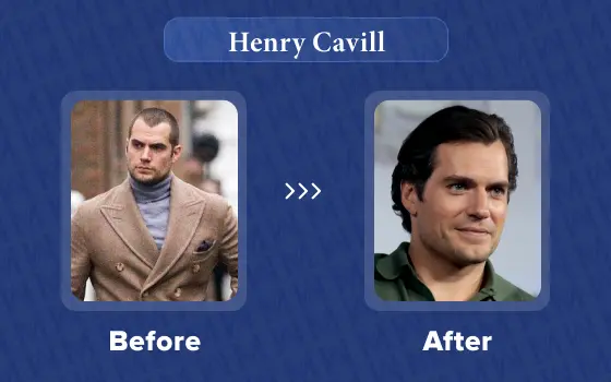 henry cavill hair transplant