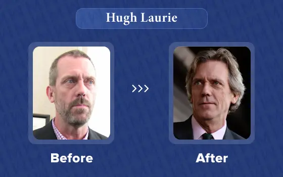 hugh laurie hair transplant