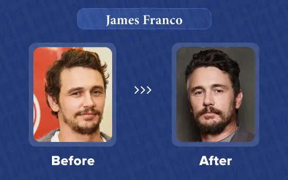 james franco hair transplant