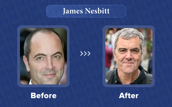 james nesbitt hair transplant