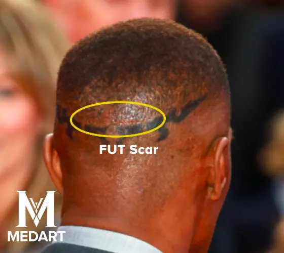 jamie foxx tribal scalp tatto covers fut hair transplant scar