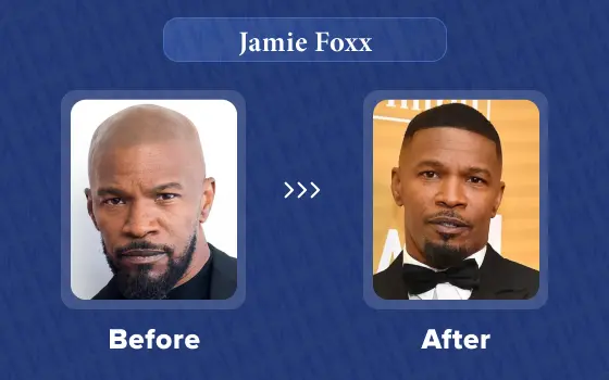 jamie foxx hair translpant